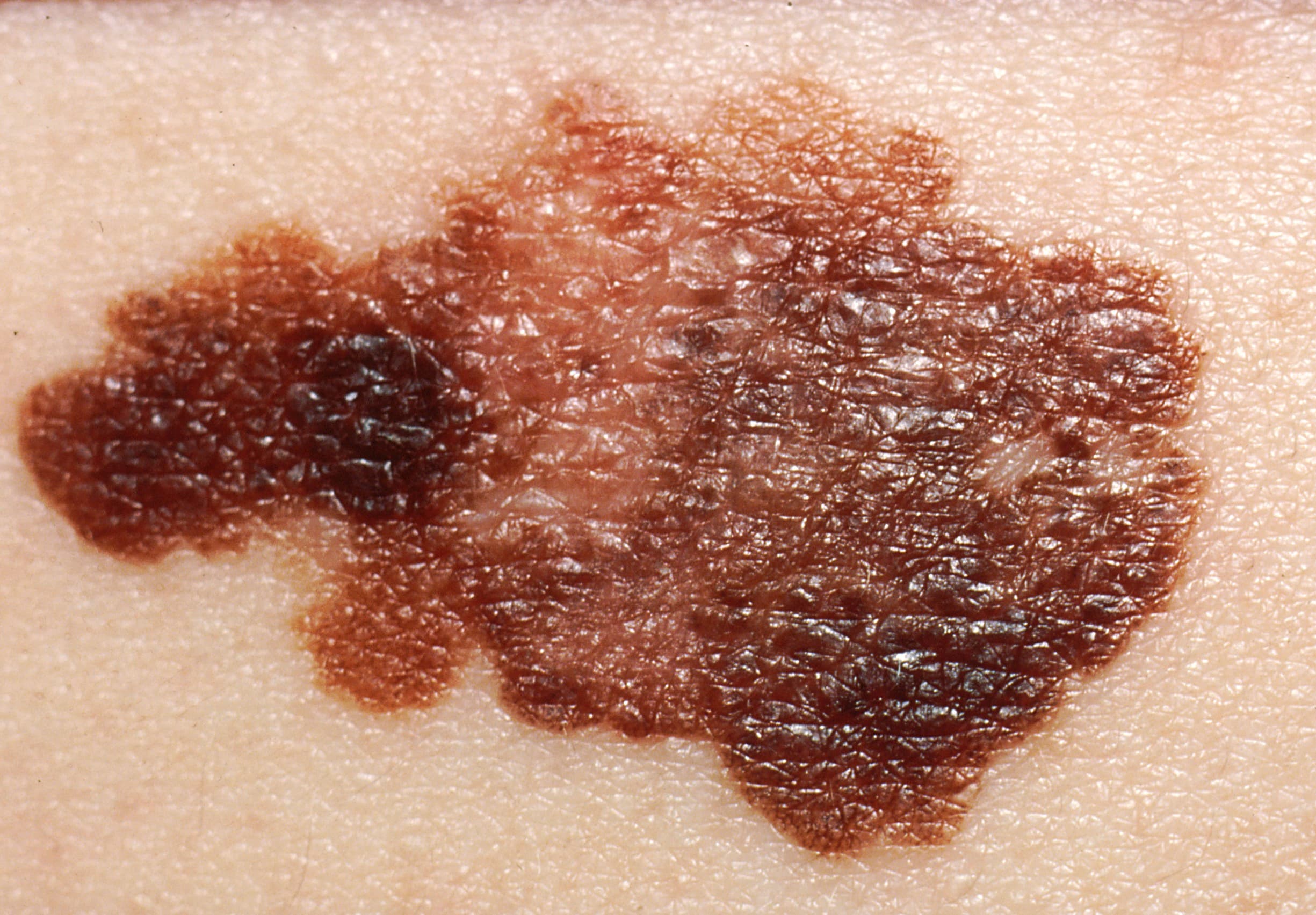 Dangerous — Possible melanoma