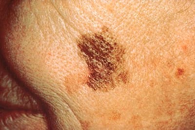 Melanom mit deutlicher Größenveränderung (> 6mm Durchmesser)