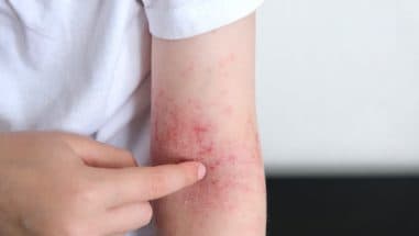 Neurodermitis (atopisches Ekzem): Ursachen, Symptome und Behandlung