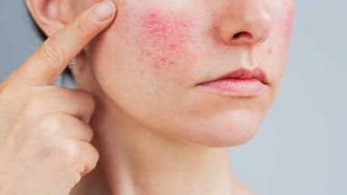 Rosacea - Ursache, Symptome und Behandlung