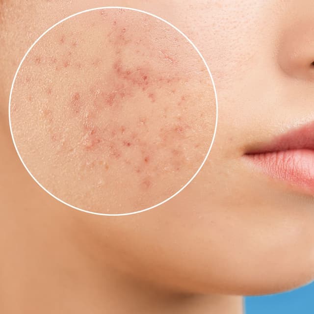 Cicatrices y Estrías