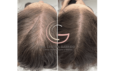 Alopecia androgénica