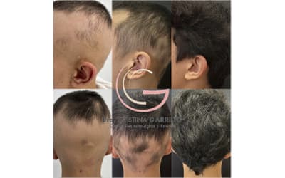 ¿Qué es la alopecia areata?