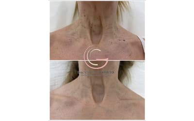 ¿Qué es la queratosis seborreicas?