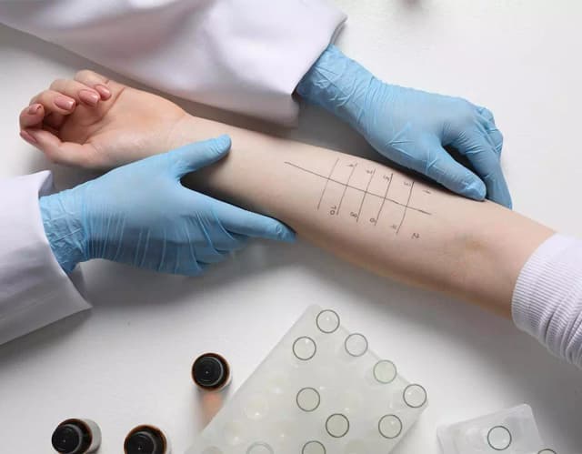 Allergologie im Hautzentrum Obere Wässere