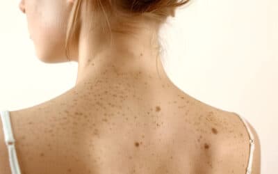 Hautkrebs bei Früherkennung heilbar