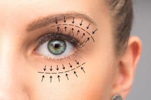 Korekce očních víček (blefaroplastika)