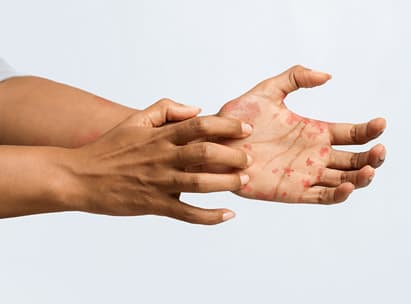 Thema Schuppenflechte (Psoriasis)