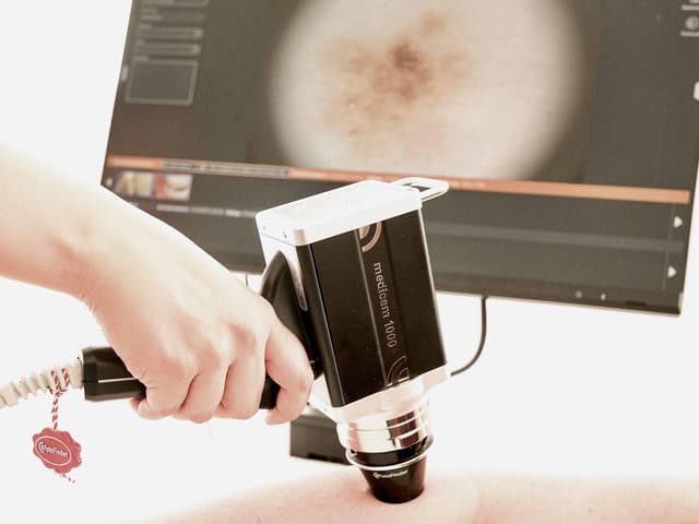 hautkrebsscreening Vorsorge mit moderner Technologie