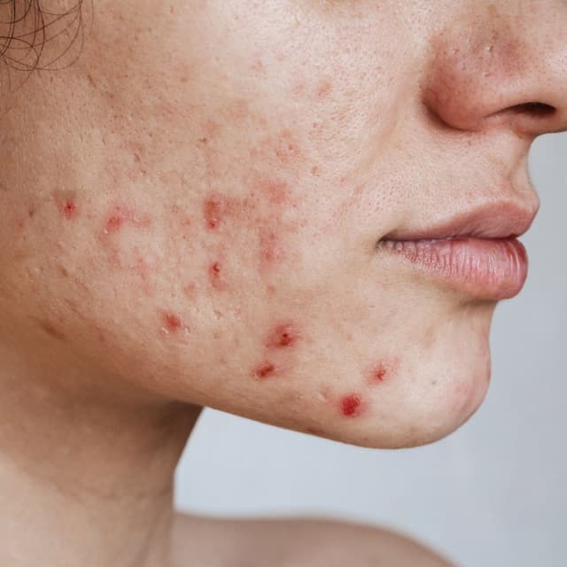 Acne behandeling