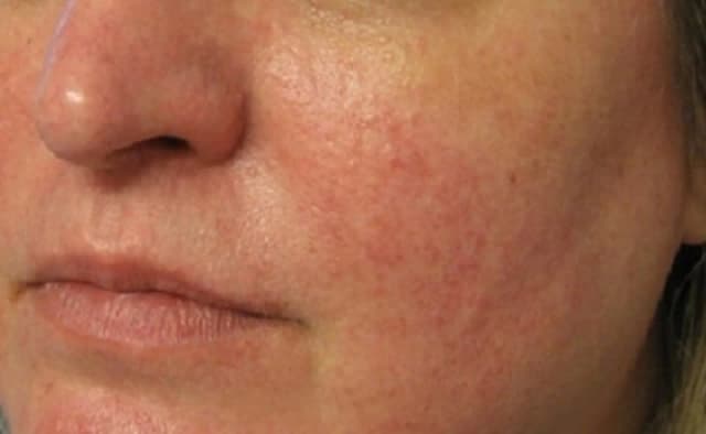 Ein halbes Gesicht einer Frau, nach der Äderchen-Entfernung.