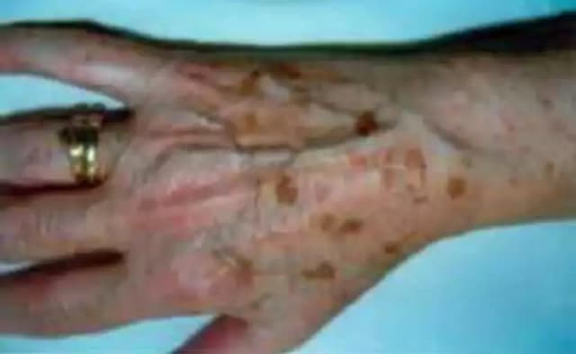 Eine Hand, auf der Pigmentflekcne zu sehen sind.