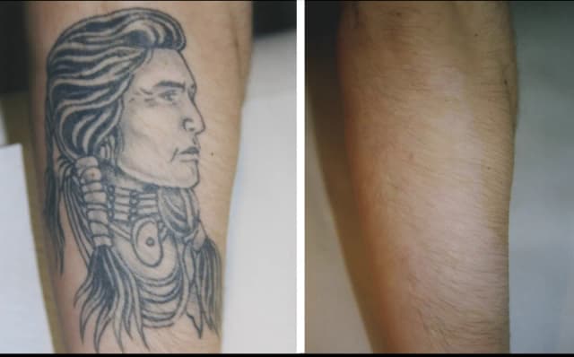 Ein vorher/nacher Beispiel einer Tattooentfernung.