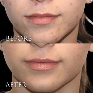 Before and after acne clearing treatment on female patient showing smoother skin β American Skin Institute.