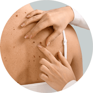 Rücken einer Person mit Muttermalen, die von einem Arzt in einer Hautarztpraxis dermatologisch untersucht wird – Fokus auf operative Dermatologie und ästhetische Hautbehandlungen in einer Hautarztpraxis für Dermatologie & Ästhetik in Leipzig.