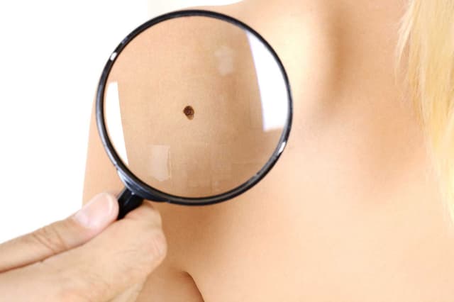 Hautarzt Dres. Dieckmann in Erlangen, Hautkrebs-/Vorsorge